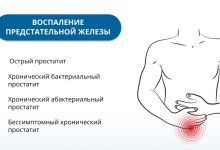 Photo of Стадии воспалительного простатита