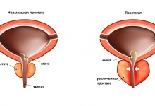 Photo of Что такое первичный простатит: стадии развития