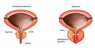 Photo of Что такое первичный простатит: стадии развития
