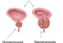Photo of Возможные причины простатита у мужчин