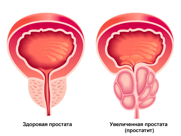 Photo of Профилактика и лечение простатита