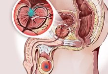 Photo of Что делает простатит опасным